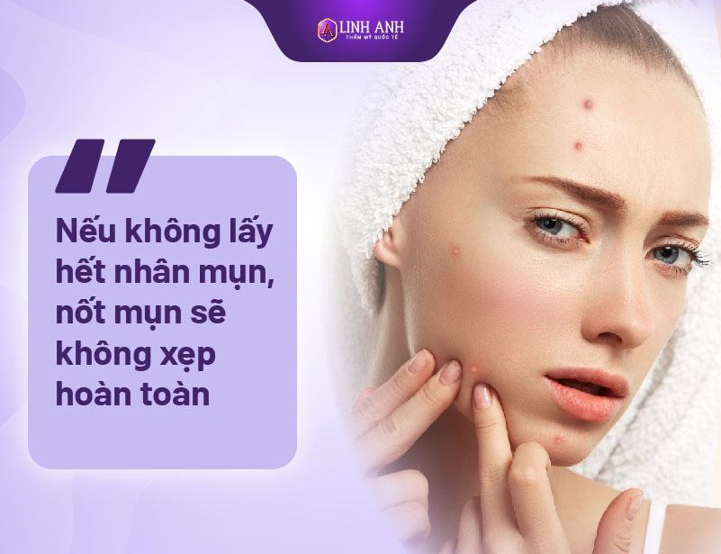 Thuốc Bôi Sau Khi Nặn Mụn Nặn Mụn Xong Nên Làm Gì Để Ngừa Thâm Tối Đa 